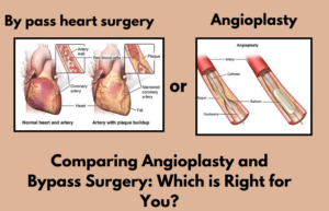 Comparing Angioplasty and Bypass Surgery: Which is Right for You?