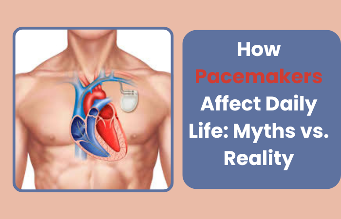 How Pacemakers Affect Daily Life: Myths vs. Reality