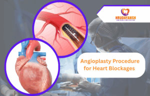 Angioplasty Procedure for Heart Blockages