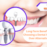 Long-Term Benefits of Choosing a Dental Implant Over Alternatives