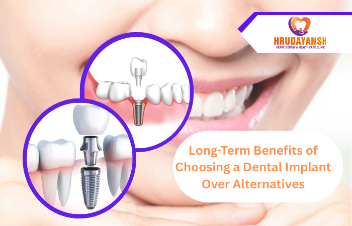 Long-Term Benefits of Choosing a Dental Implant Over Alternatives