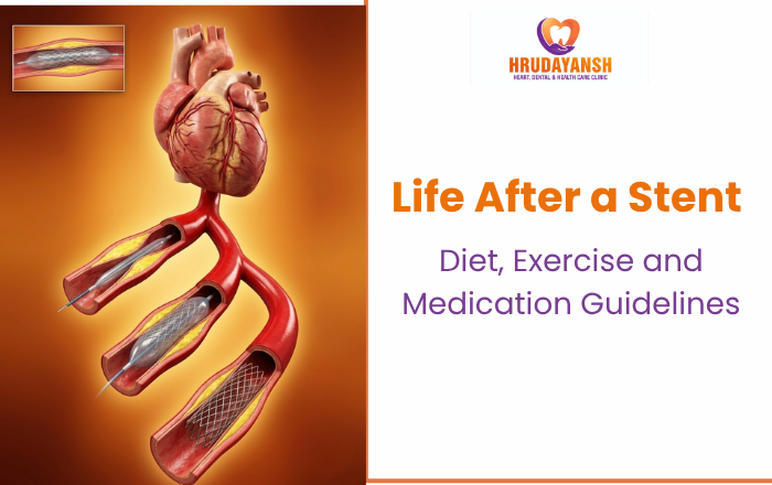 Life After a Stent: Diet, Exercise and Medication Guidelines